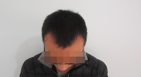 成都雍禾植發(fā)1500單位，額角頭發(fā)滿了，還找到了我心愛(ài)的女朋友