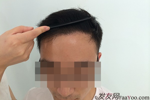 成都雍禾植發(fā)1500單位，額角頭發(fā)滿了，還找到了我心愛(ài)的女朋友