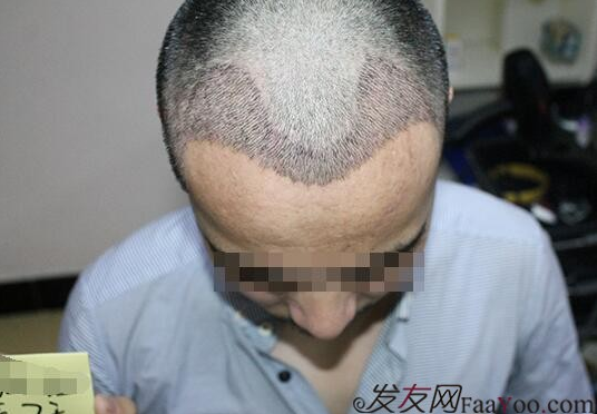 上海雍禾植發(fā)以后都說我變帥了，其實我想說感謝雍禾植發(fā)