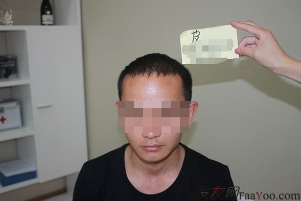 石家莊雍禾植發(fā)2640毛囊單位，技術(shù)真的很好