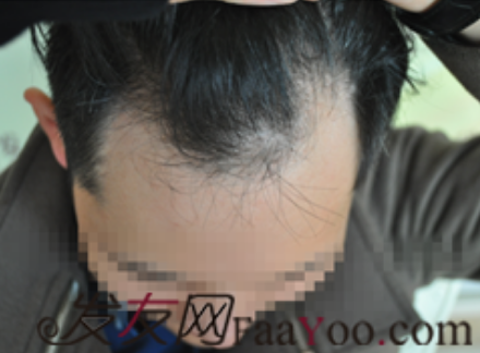 大麥微針勇哥植發(fā)記，植發(fā)后的效果兩個字完美