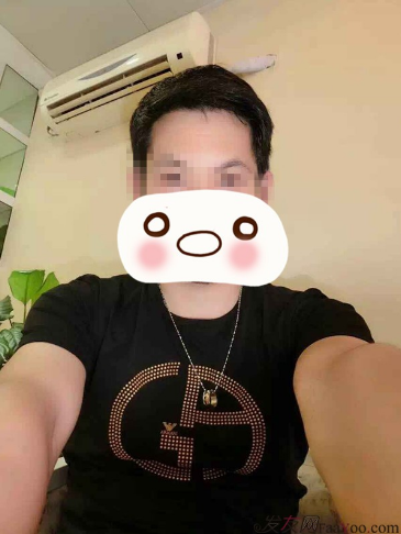 大麥微針勇哥植發(fā)記，植發(fā)后的效果兩個字完美