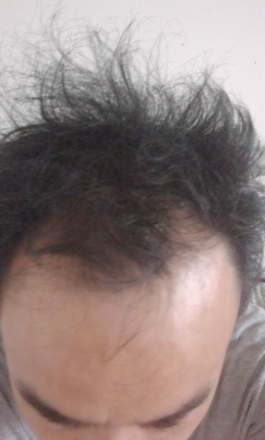 新疆去北京植發(fā)經(jīng)歷，2600毛囊單位看看手術(shù)前手術(shù)后