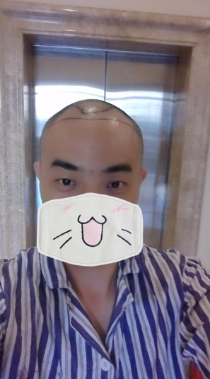 新疆去北京植發(fā)經(jīng)歷，2600毛囊單位看看手術(shù)前手術(shù)后