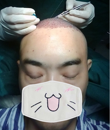 新疆去北京植發(fā)經(jīng)歷，2600毛囊單位看看手術(shù)前手術(shù)后