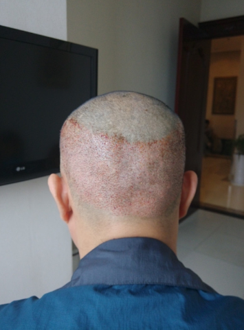 新疆去北京植發(fā)經(jīng)歷，2600毛囊單位看看手術(shù)前手術(shù)后