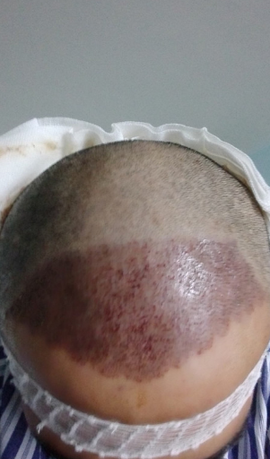 新疆去北京植發(fā)經(jīng)歷，2600毛囊單位看看手術(shù)前手術(shù)后