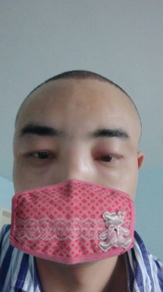 新疆去北京植發(fā)經(jīng)歷，2600毛囊單位看看手術(shù)前手術(shù)后