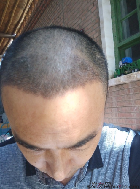 新疆去北京植發(fā)經(jīng)歷，2600毛囊單位看看手術(shù)前手術(shù)后