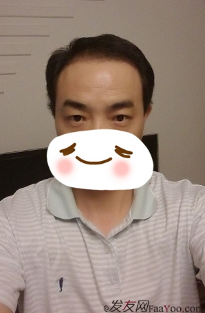 新疆去北京植發(fā)經(jīng)歷，2600毛囊單位看看手術(shù)前手術(shù)后