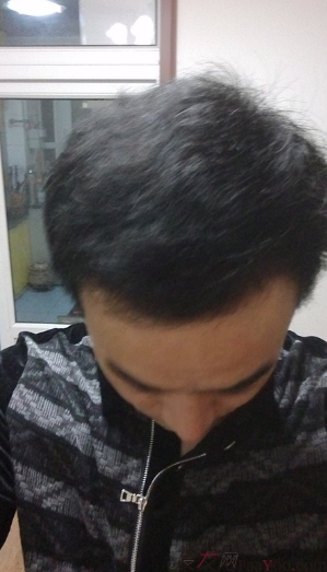 新疆去北京植發(fā)經(jīng)歷，2600毛囊單位看看手術(shù)前手術(shù)后
