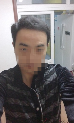 新疆去北京植發(fā)經(jīng)歷，2600毛囊單位看看手術(shù)前手術(shù)后