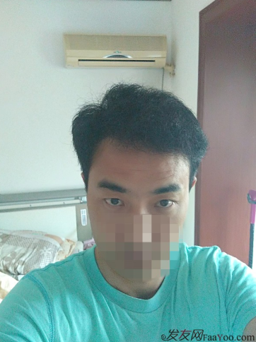 新疆去北京植發(fā)經(jīng)歷，2600毛囊單位看看手術(shù)前手術(shù)后