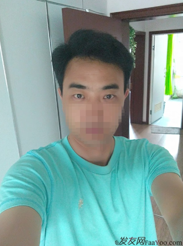 新疆去北京植發(fā)經(jīng)歷，2600毛囊單位看看手術(shù)前手術(shù)后