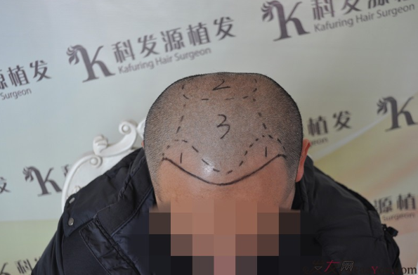 博士生在南京大麥微針植前額發(fā)際線2700單位，來(lái)看看前后對(duì)比效果