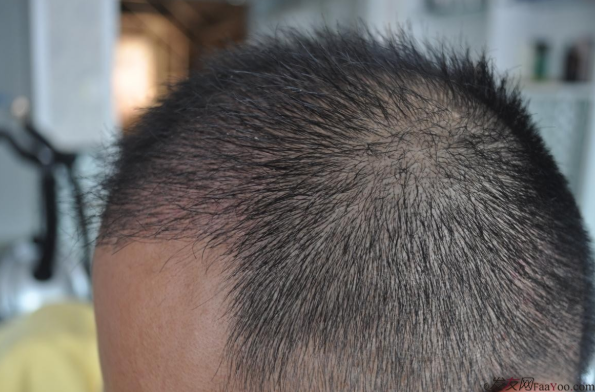 博士生在南京大麥微針植前額發(fā)際線2700單位，來(lái)看看前后對(duì)比效果