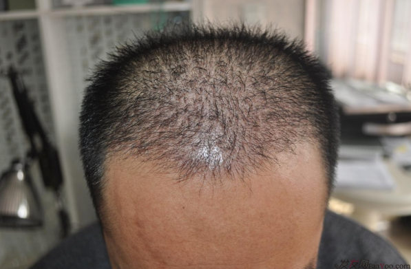 博士生在南京大麥微針植前額發(fā)際線2700單位，來(lái)看看前后對(duì)比效果