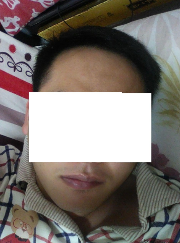 博士生在南京大麥微針植前額發(fā)際線2700單位，來(lái)看看前后對(duì)比效果