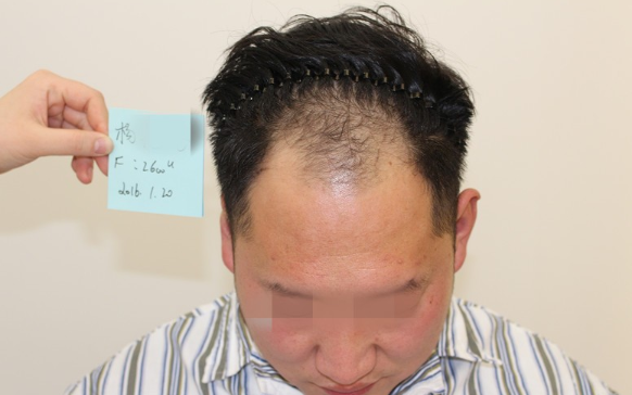 鄭州雍禾植發(fā)后七天，2600單位還是值得信任的