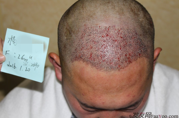 鄭州雍禾植發(fā)后七天，2600單位還是值得信任的