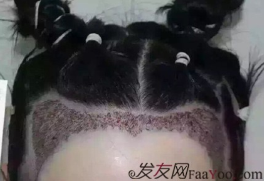 北京真實案例告訴你植發(fā)效果怎么樣？看看一年后的效果