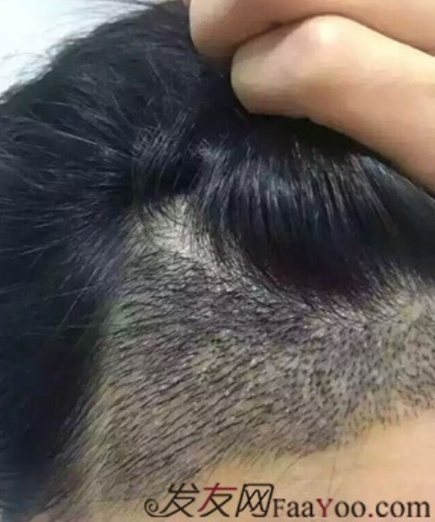 北京真實案例告訴你植發(fā)效果怎么樣？看看一年后的效果