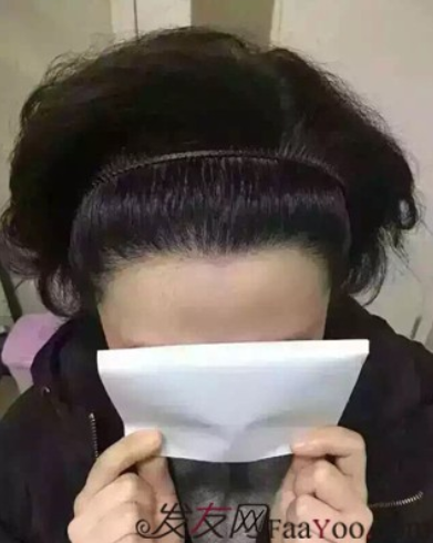 北京真實案例告訴你植發(fā)效果怎么樣？看看一年后的效果