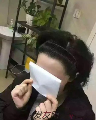 北京真實案例告訴你植發(fā)效果怎么樣？看看一年后的效果