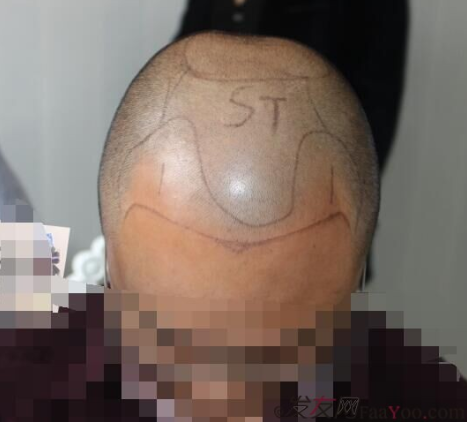 大麥微針植發(fā)3500單位，7個小時后我重拾年輕的心