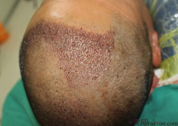 大麥微針植發(fā)3500單位，7個小時后我重拾年輕的心