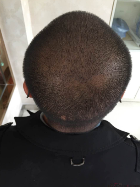 大麥微針植發(fā)3500單位，7個小時后我重拾年輕的心