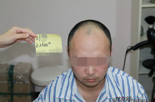 上海雍禾植發(fā)2500單位，一下子年輕了10歲，想要植發(fā)的朋友可以看看