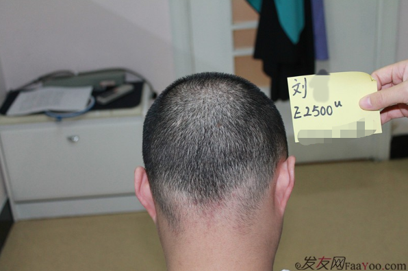 上海雍禾植發(fā)2500單位，一下子年輕了10歲，想要植發(fā)的朋友可以看看