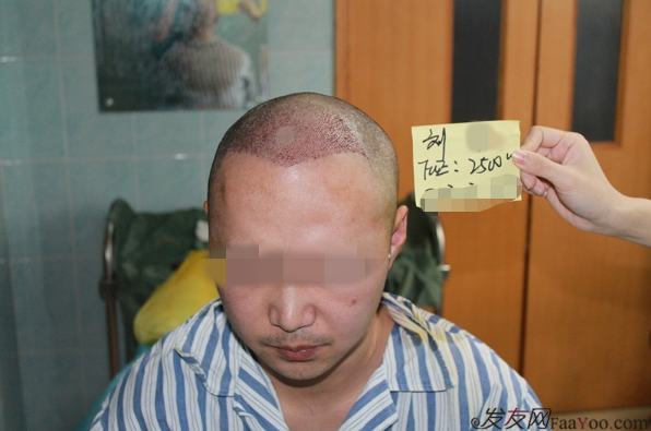 上海雍禾植發(fā)2500單位，一下子年輕了10歲，想要植發(fā)的朋友可以看看