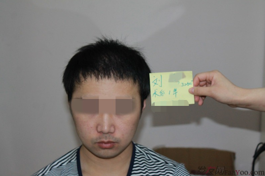 上海雍禾植發(fā)2500單位，一下子年輕了10歲，想要植發(fā)的朋友可以看看