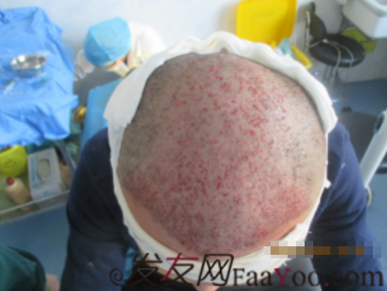 下定決心在上海做了植發(fā)，看看這一個(gè)月的恢復(fù)情況