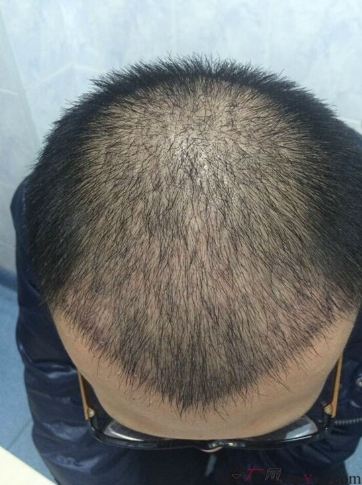 下定決心在上海做了植發(fā)，看看這一個(gè)月的恢復(fù)情況