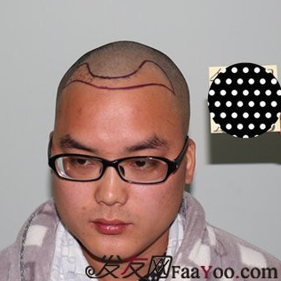 在青島把額角種植2000單位植完了，頭發(fā)終于解放了