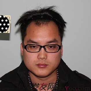 在青島把額角種植2000單位植完了，頭發(fā)終于解放了