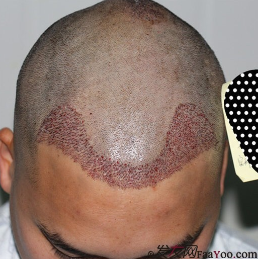 在青島把額角種植2000單位植完了，頭發(fā)終于解放了