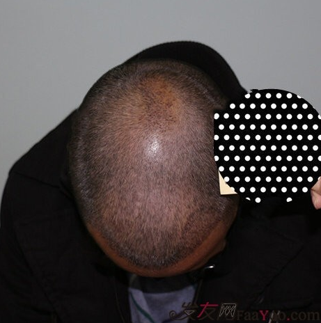 在青島把額角種植2000單位植完了，頭發(fā)終于解放了