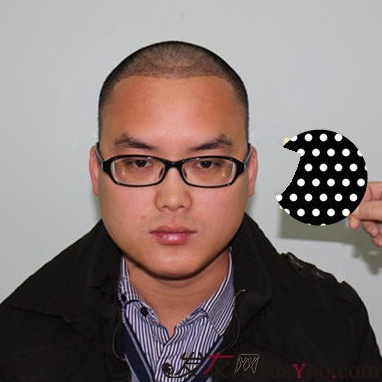 在青島把額角種植2000單位植完了，頭發(fā)終于解放了