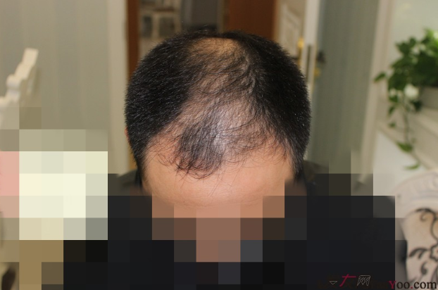 3170單位FUE+PTT杭州大麥微針植發(fā)記，蛻變之路，期待化蛹成蝶