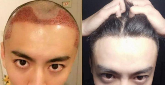 東莞植發(fā)多少錢，在東莞正規(guī)植發(fā)醫(yī)院真實(shí)經(jīng)歷