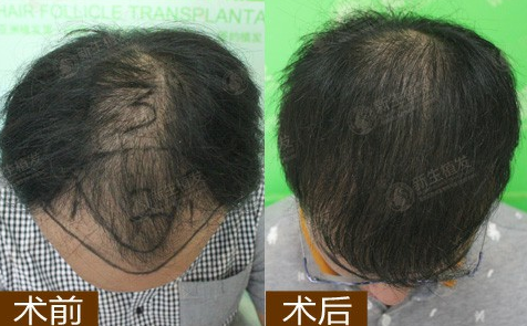 蘇州哪家植發(fā)醫(yī)院靠譜？在蘇州新生植發(fā)了3000毛囊單位