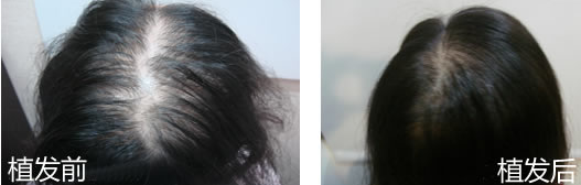 合肥植發(fā)多少錢，效果怎么樣？在合肥新生植發(fā)醫(yī)院的真實(shí)經(jīng)歷
