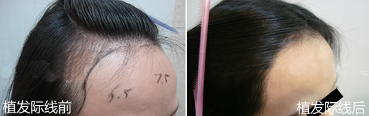 我在杭州大麥微針種植發(fā)際線1500單位，手術(shù)效果怎么樣