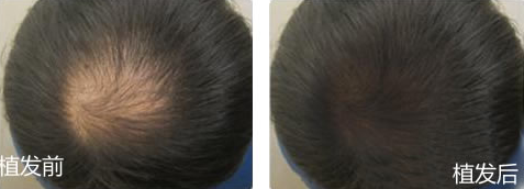 重慶植發(fā)效果多少錢?我植發(fā)1500單位親身經(jīng)歷告訴你效果好不好