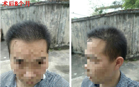 山西大麥微針頭頂大面積植發(fā)3500單位，看看植發(fā)效果如何