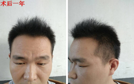 山西大麥微針頭頂大面積植發(fā)3500單位，看看植發(fā)效果如何